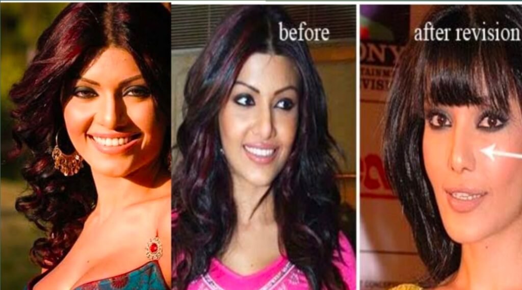 Bollywood celebrities ruined by surgery 